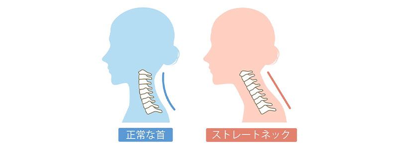 ストレートネックのイメージ